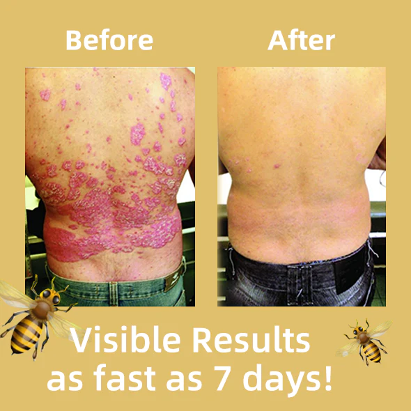 Cvreoz Bee Venom Psoriasis Treatment Cream - Image 3