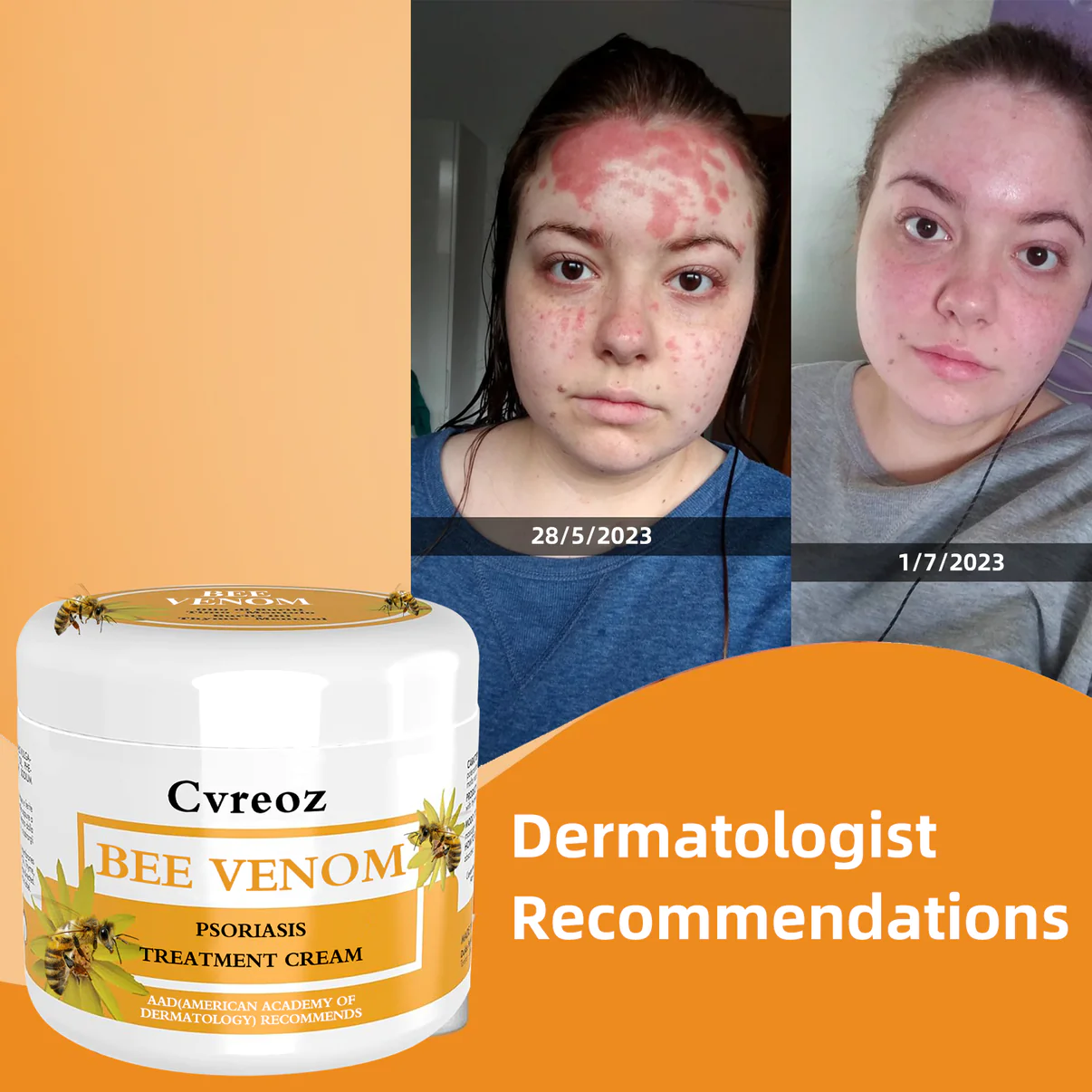 Cvreoz Bee Venom Psoriasis Treatmen - Image 4