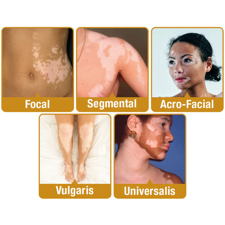 BeeVenom Vitiligo Treatment Cream - Image 6