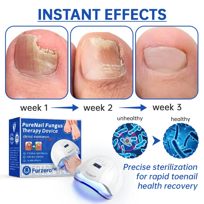 PureNail Fungus Laser Device - Image 6