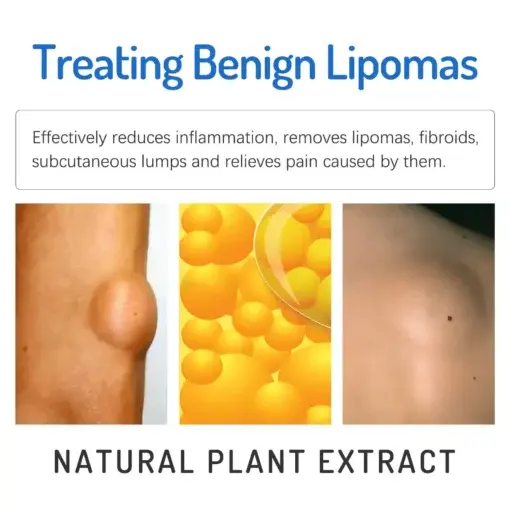 LIPOMA CREAM - Image 6