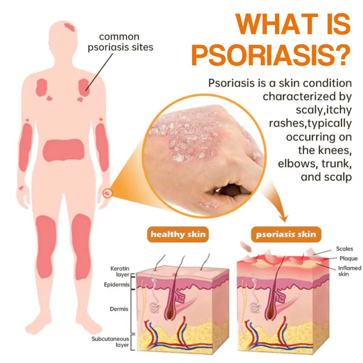 PsoriaHeal psoriasis Spray - Image 2