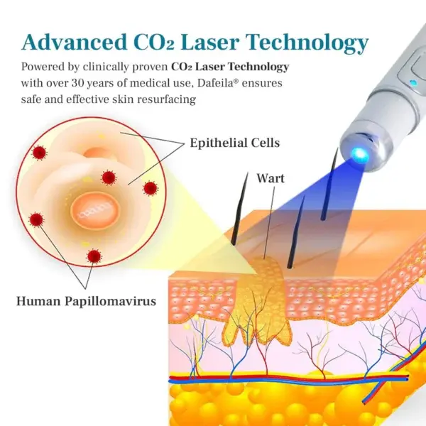 LumeSkin Mole and Wart Removal Laser Pen - Image 4