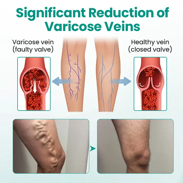 LegRenew Varicose Veins Patch - Image 5
