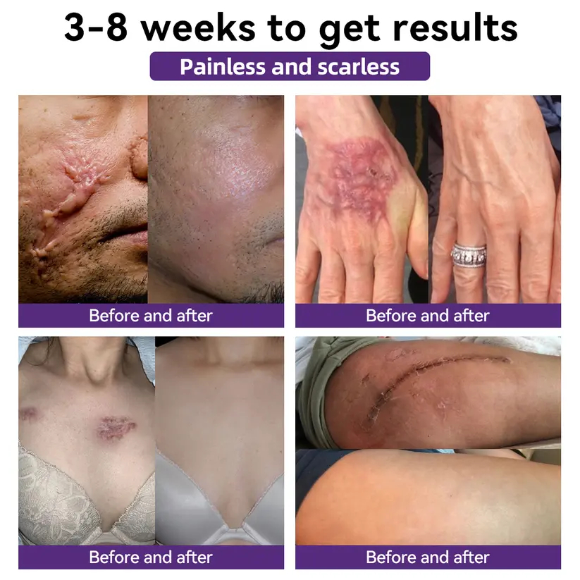 Advanced Scar Gel - Image 3