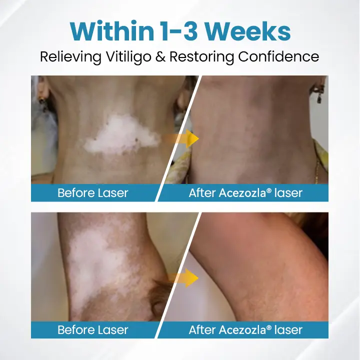 DermaBeam Vitiligo Therapy Device - Image 5