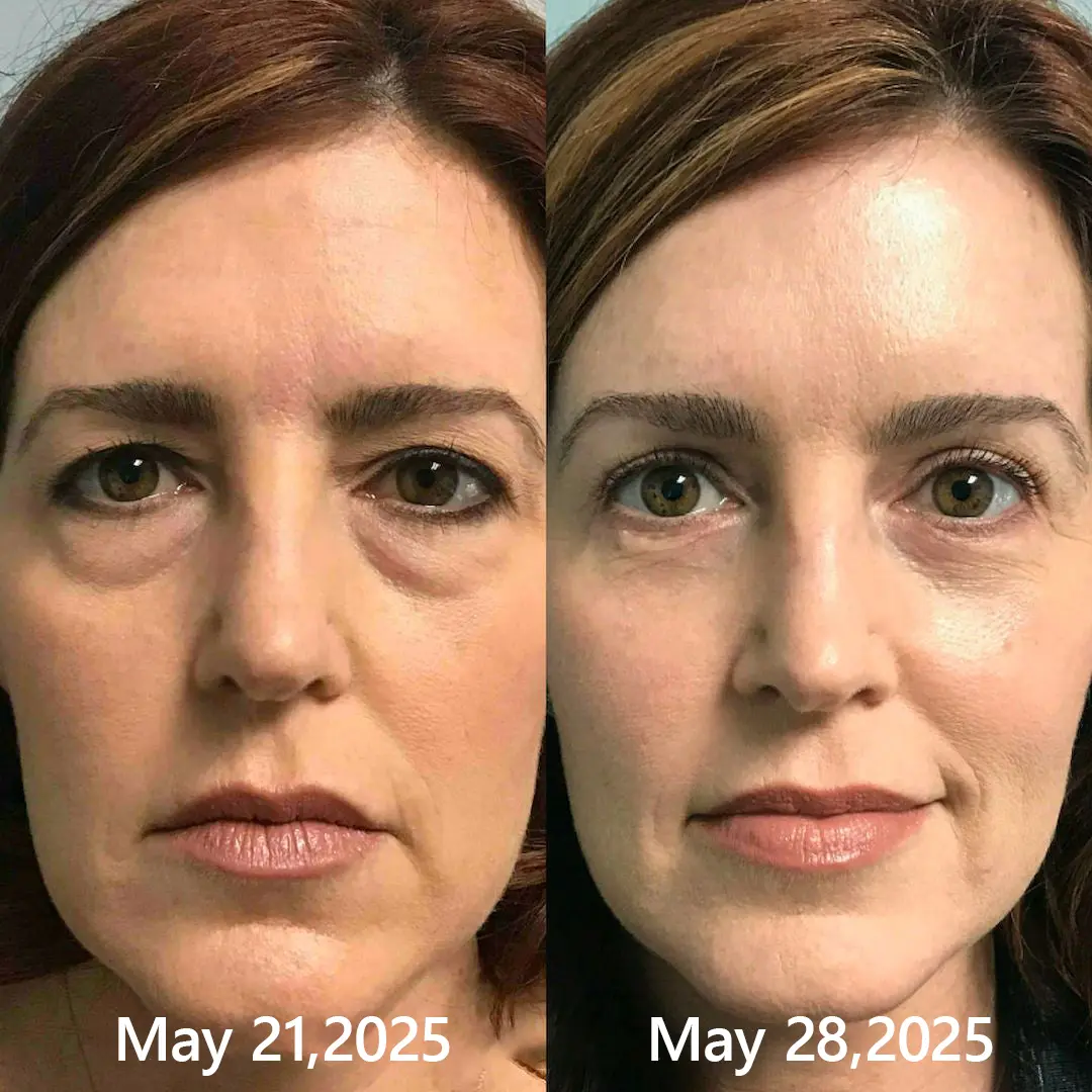 BOTOX & VITA A RETINOL SHOT Wrinkle Lift Tightening Cream - Image 50