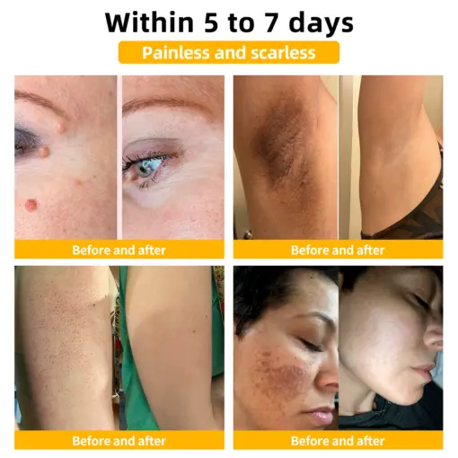 Bee Venom Mole and Wart Treatment Cream - Image 6