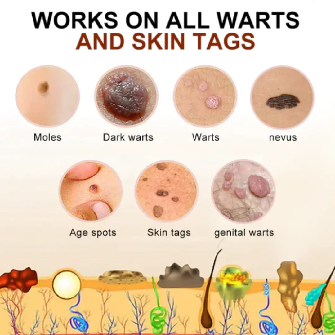 Bee Venom Mole and Wart Treatment Cream - LIMITED-TIME OFFER - Image 17
