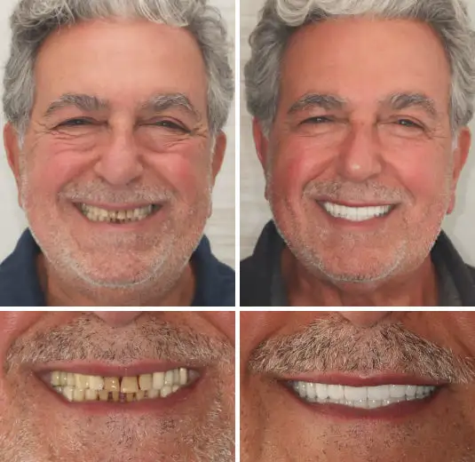 Premium Denture - Image 7