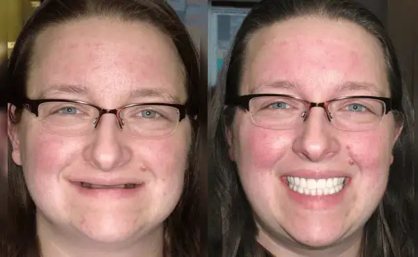 Premium Denture - Image 8