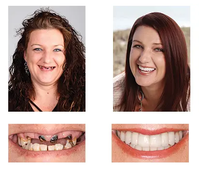 Custom-Fit Functional Dentures - Image 8