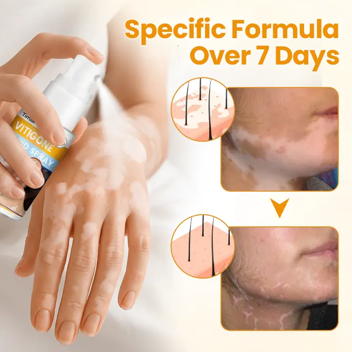 VitiGone Rapid Spray — 2–3 Week Repigmentation with OTDS - Image 9