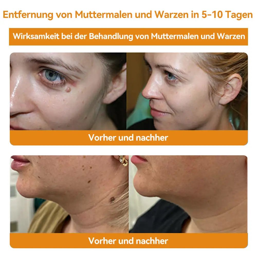 Bienengift Waren & Muttermalenfernung Creme - Image 12