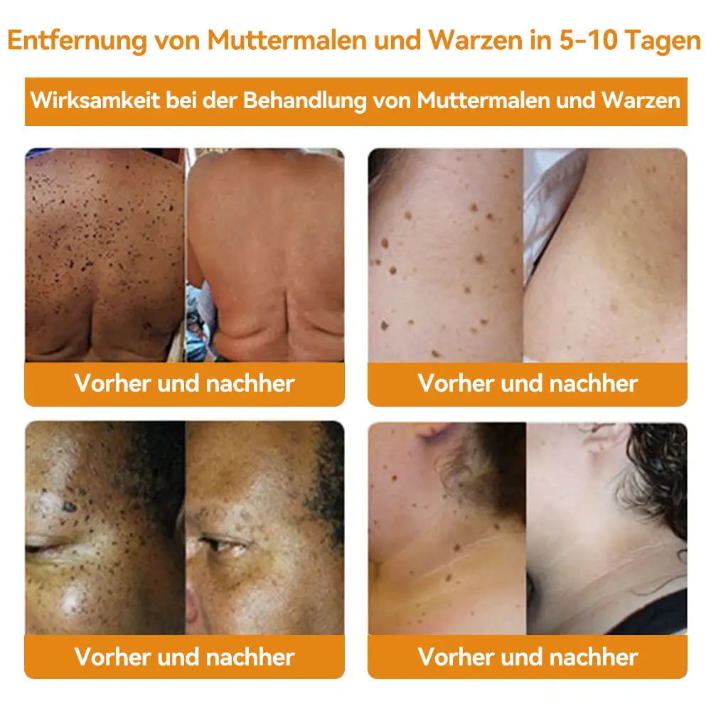 Bienengift Waren & Muttermalenfernung Creme - Image 5