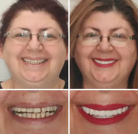 Advanced Customized Full Denture Set - Image 8