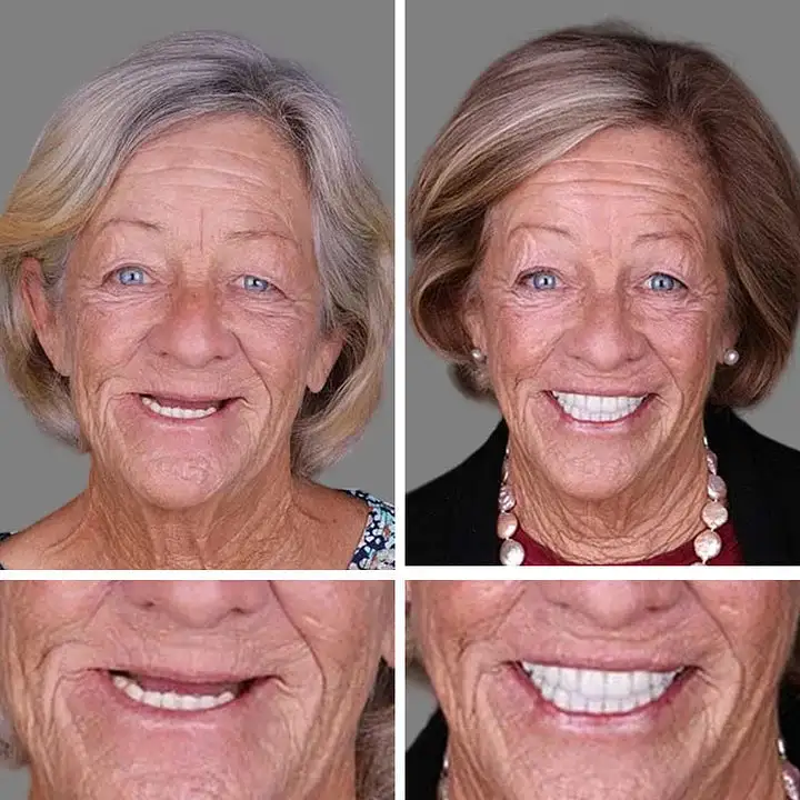 Medical Full Denture with Strong Suctiond Custom-Fit Full Functional Dentures - Image 11