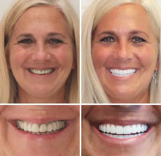 Advanced Customized Full Denture Set - Image 5