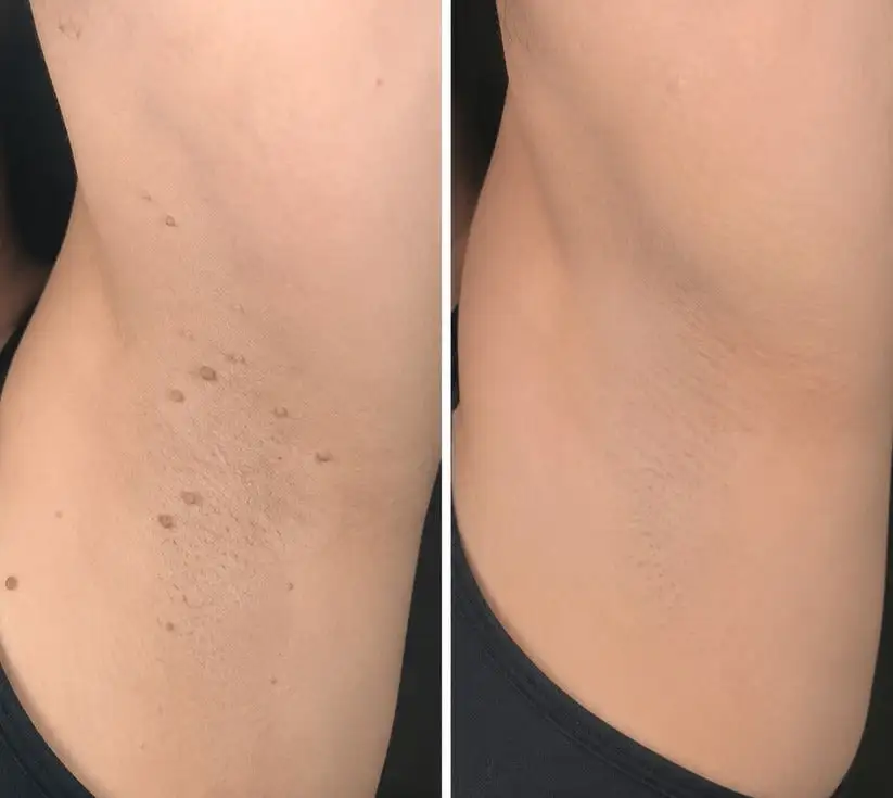 2-in-1 Microneedle & Hydrocolloid Patch - Image 11