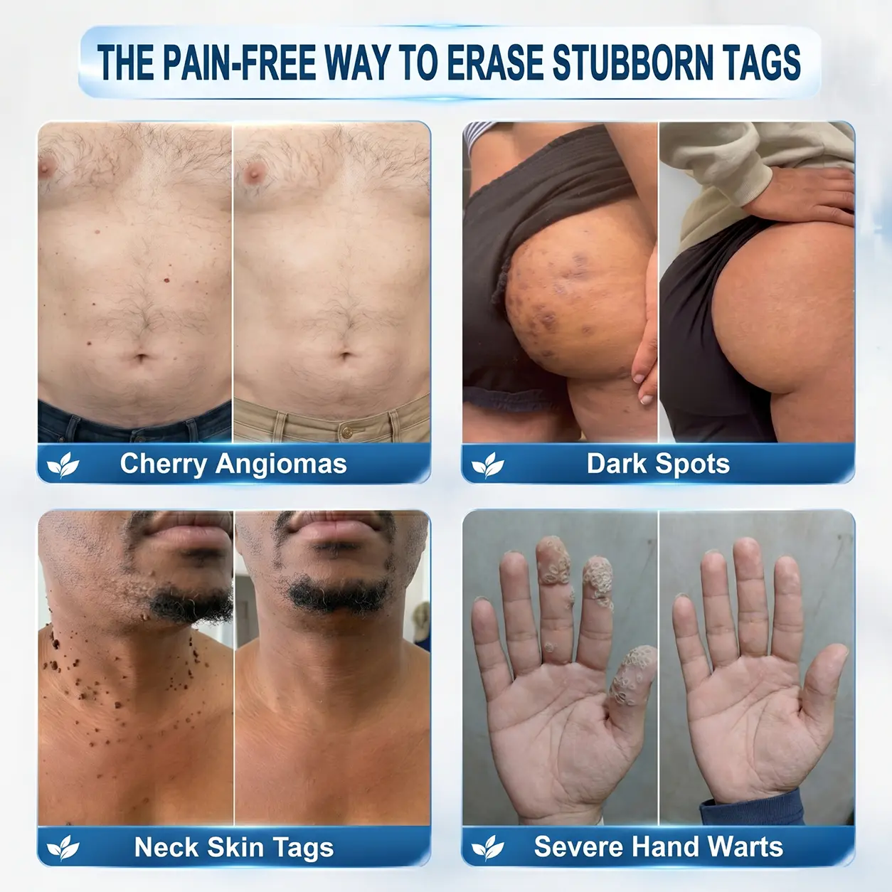 Advanced Wart Removal Gel · Fast-Drying Targeted Care for Common Warts - Image 3