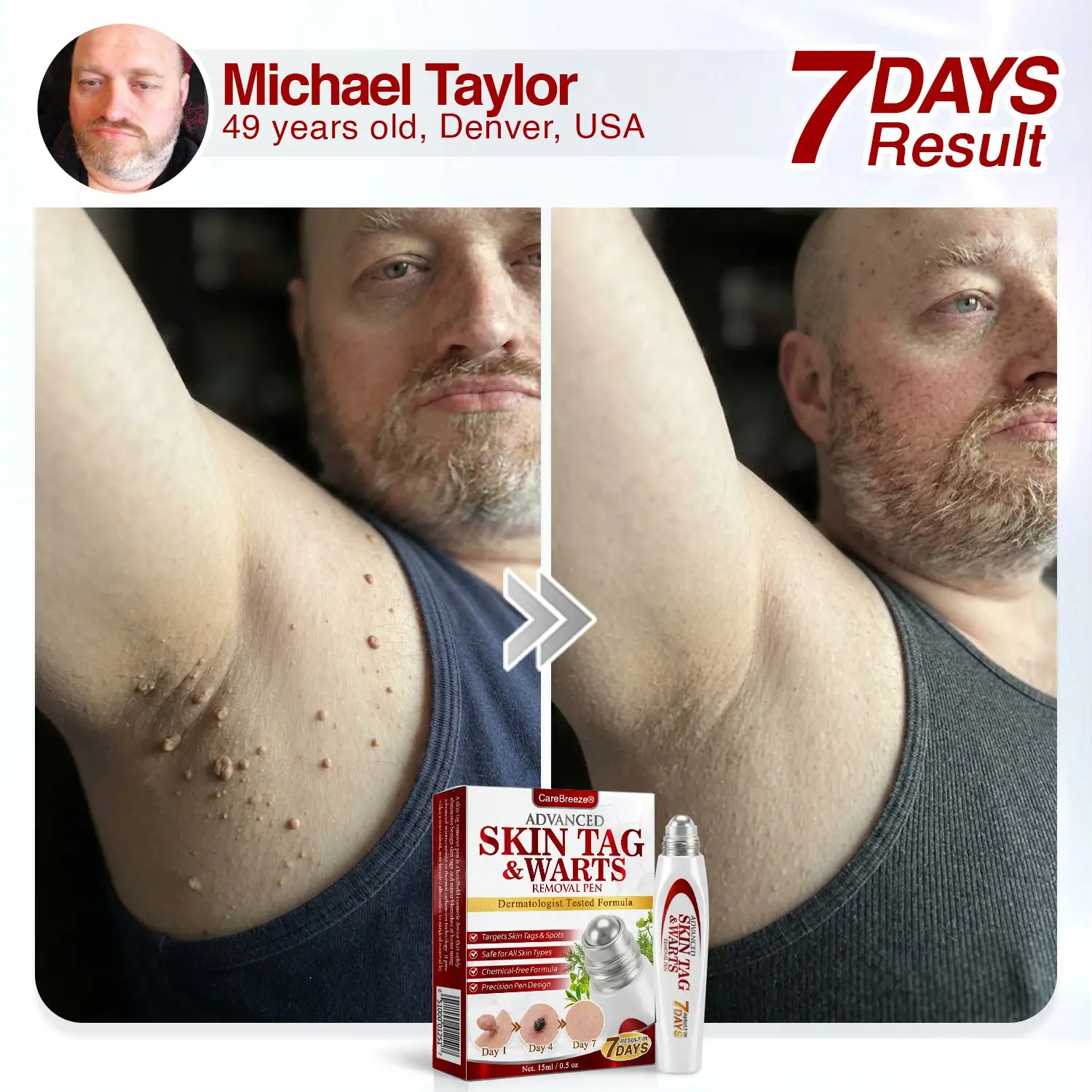Herbal Skin Tag & Wart Removal Roller - Image 5