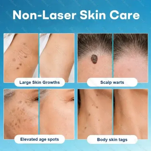 7 -Day Wart & Blemish Remover - Image 2